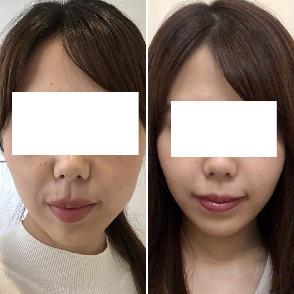 東京中央美容外科の糸リフト Tcb式小顔美肌再生 の効果 ダウンタイム ビフォーアフターレポ Melo Blog